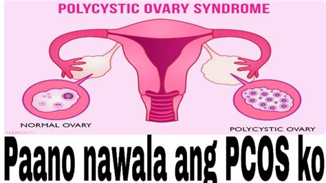 paano malalaman na may pcos ka|Polycystic Ovary Syndrome (PCOS) .